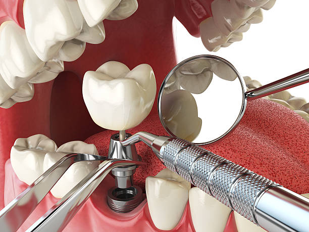 Best Dental Abscess Treatment in Chama, NM