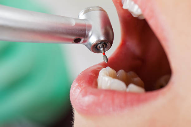 Best Knocked-Out Tooth (Avulsed Tooth) Treatment in Chama, NM